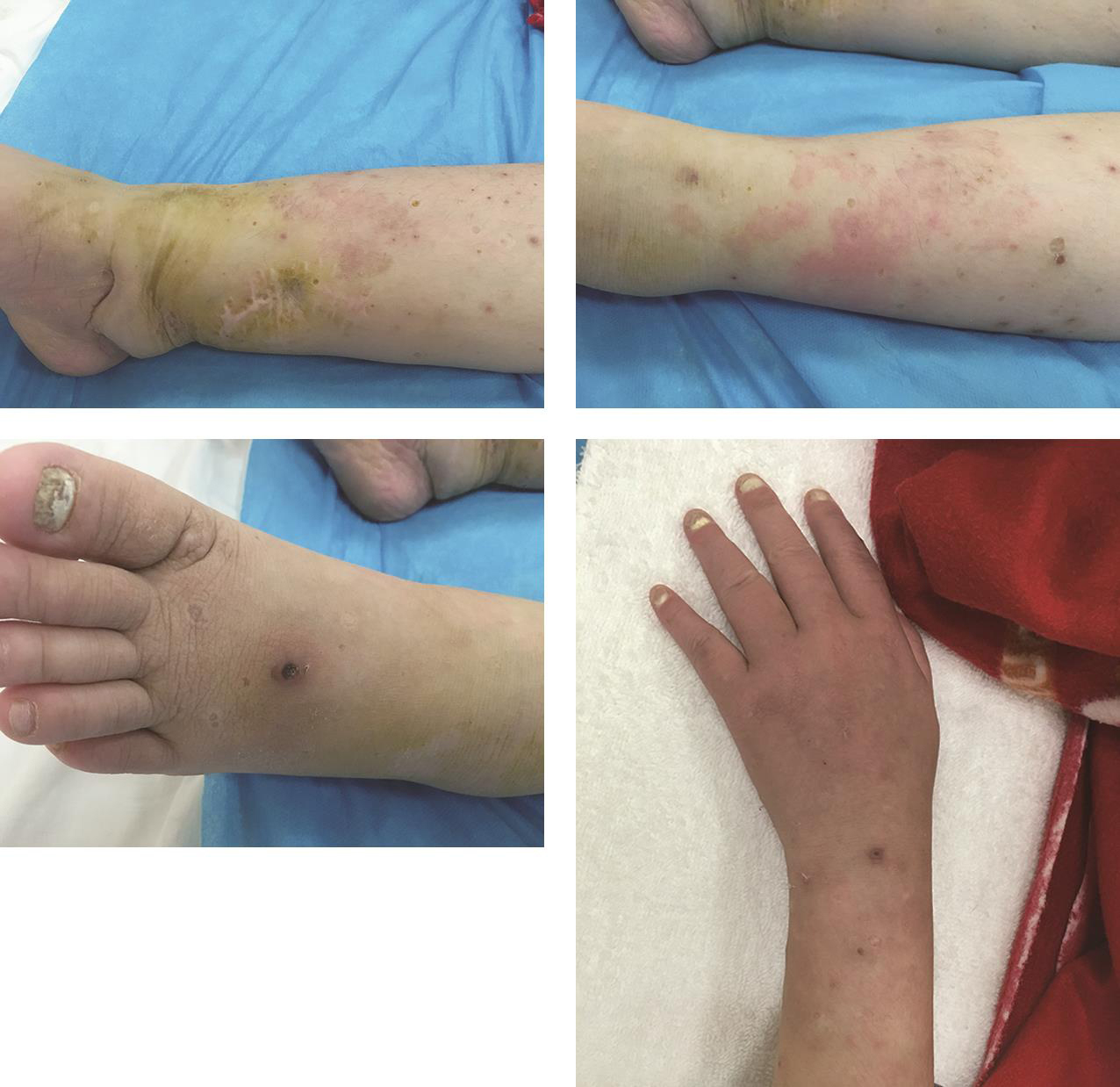 图1 皮疹和灰指趾甲.jpg